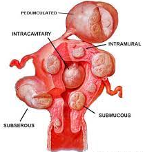 Fibroame uterine
