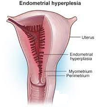 Hiperplazie endometriala 2