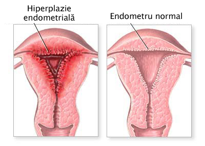 Hiperplazie endometriala