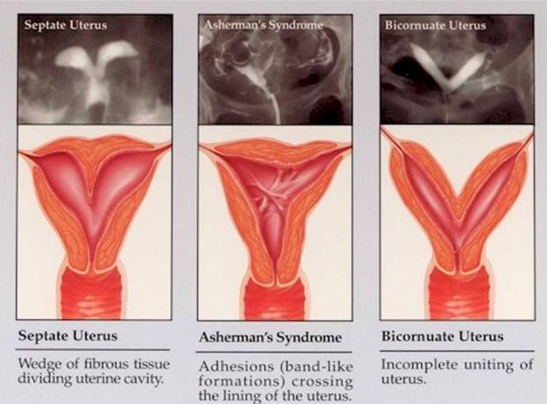 sinechie_uterina